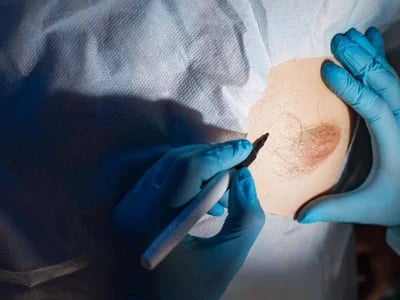 Warum eine Brustvergrößerung mit Straffung in der modernen Chirurgie bevorzugt wird