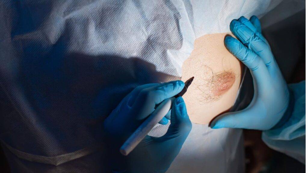 Warum eine Brustvergrößerung mit Straffung in der modernen Chirurgie bevorzugt wird